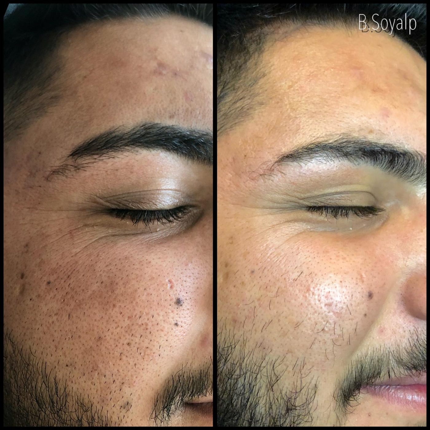 Cilt bakımı — Begüm Soyalp Atelier Bursa